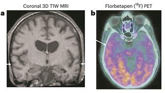 阿爾茨海默病真能傳染嗎