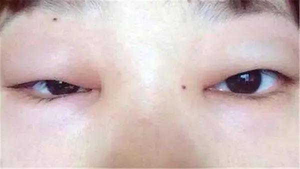 早上醒來後“水腫”的人，別忽略這幾個病因