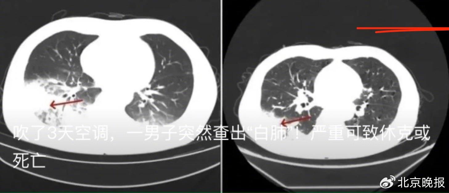 空調吹成白肺？這個致病菌到底從何而來