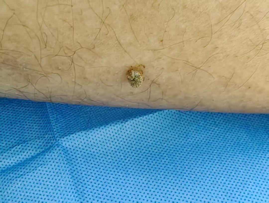 蜱蟲又又又來了！別硬拔，已有人中招