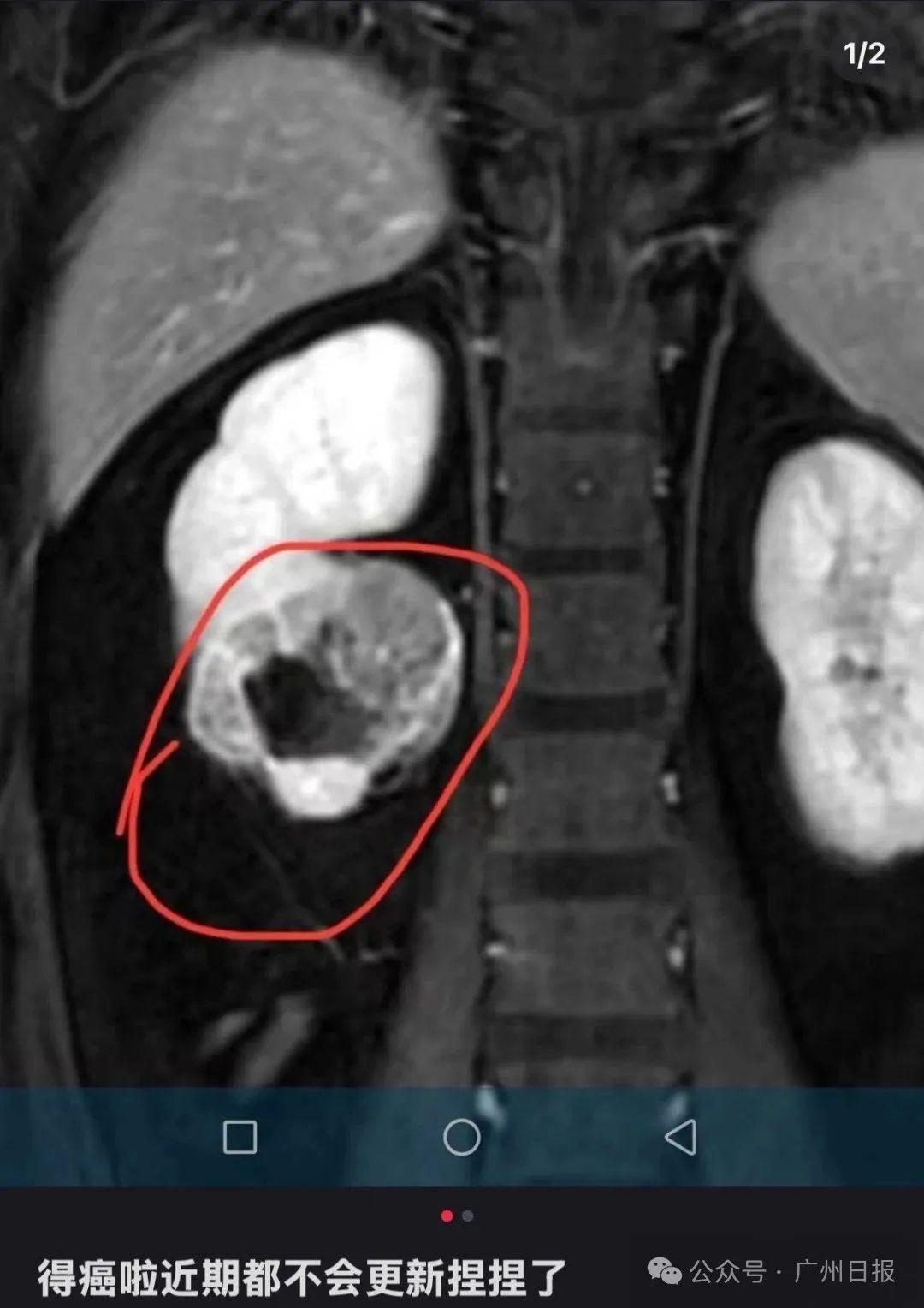 甲醛超標數十倍！浙江人快自查！有人自曝已患癌……