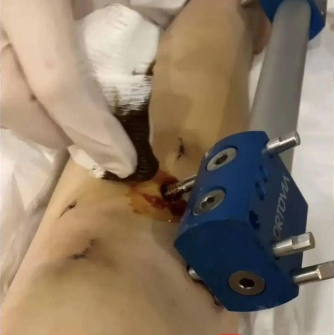 觸目驚心！女子花60萬“斷骨增高”13釐米，卻落下終身疾病……