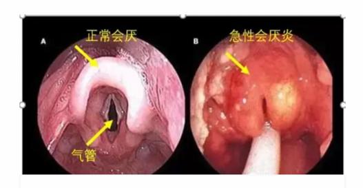 26歲女子從緊急就診到去世僅10分鐘！這種病千萬別以爲是上火了
