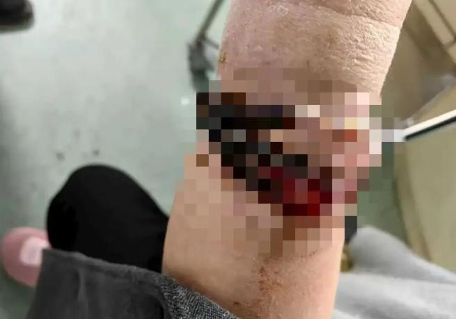 女子手鐲10年沒摘竟“長”進肉裏！醫生：再晚點可能危及生命
