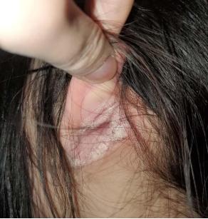 杭州女生患上怪病！一到傍晚就全身癢……