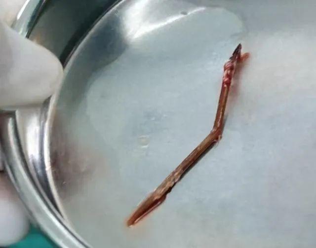 久治不愈！男子剔牙誤將牙籤吸入肺中感染肺炎，醫生提醒：嚴重可危及生命