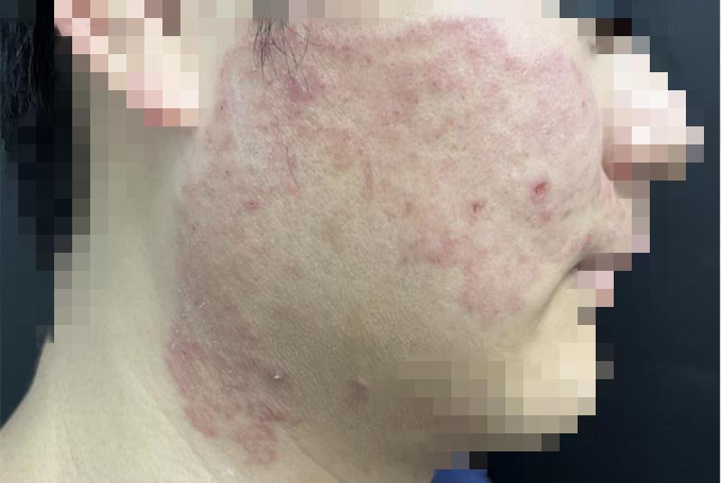 把擦腳巾當洗臉巾竟導致“腳氣”上臉，寧波27歲帥小夥慘不忍睹！醫生：一人感染，可傳染全家！很多人沒當回事