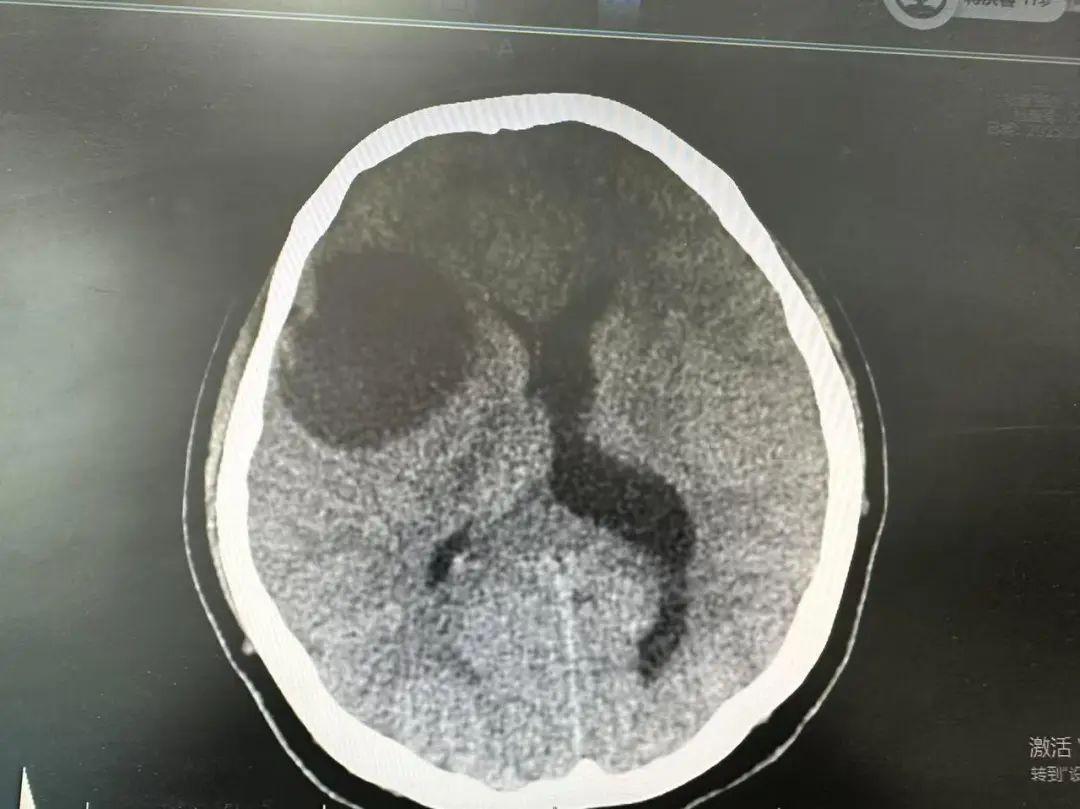 女子被頭疼折磨三個月，一查竟是腦腫瘤！別覺得年輕就放鬆警惕