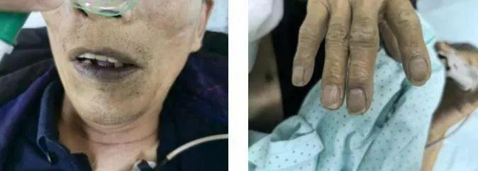 一碗下肚，中毒變“紫”了！這道菜很多人愛喫……