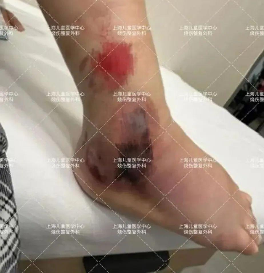 6歲女孩發生意外，父母3天后發現不對勁！這個戶外活動很多上海人都愛