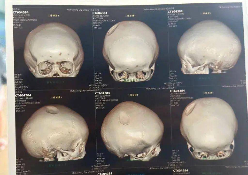 心疼！8歲小孩遭醉漢用椅子砸頭，“要做開顱手術”