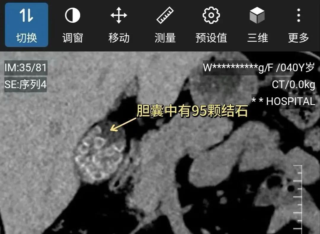 “就像開盲盒開到水晶礦洞！”女子體內長了近百顆結石！這個習慣很多人都有