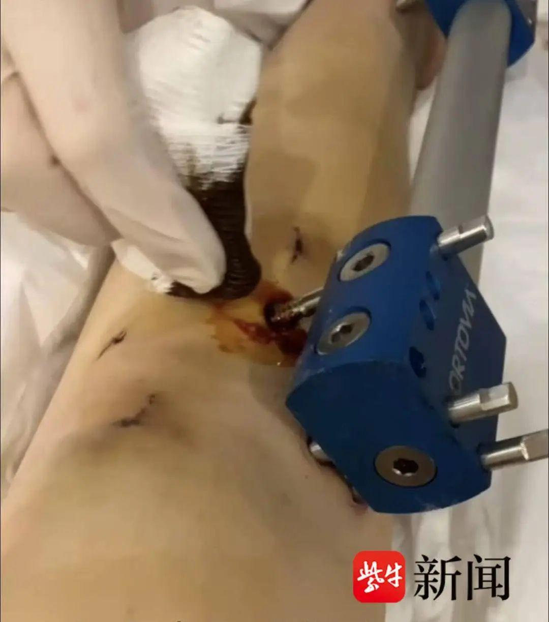 江蘇女孩花60萬去國外“斷骨增高”13cm，後怕的事發生了：像有顆定時炸彈藏在身體裏