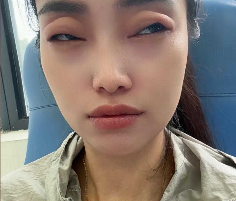 2顆楊梅下肚，女子眼睛差點看不見了！正大量上市，有人喫到要搶救……
