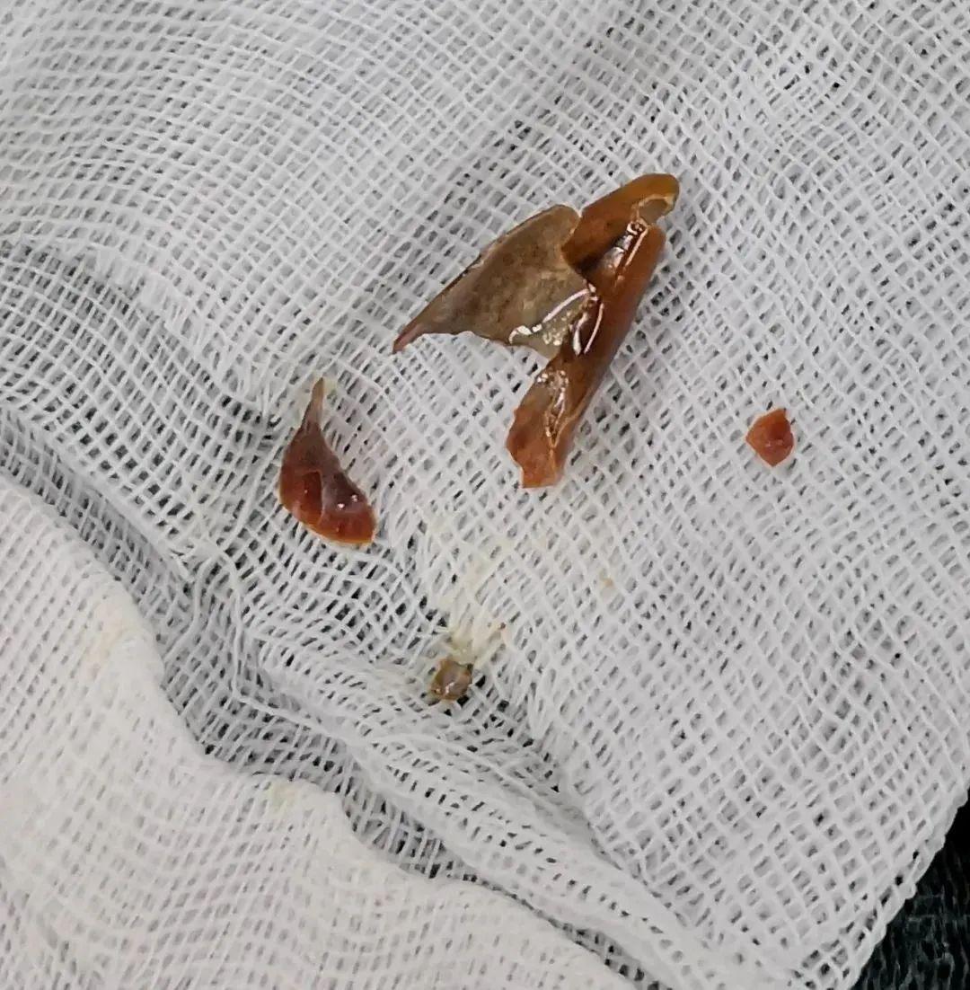 一塊辣椒皮惹禍！浙江男子高燒40℃，肺部大片感染！醫生提醒這個動作很危險