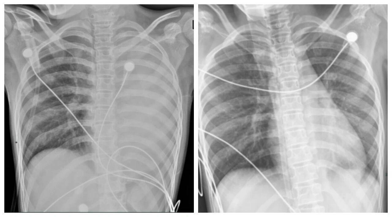 發熱1天左肺全白！這種病可堵塞氣道，別誤當普通感冒