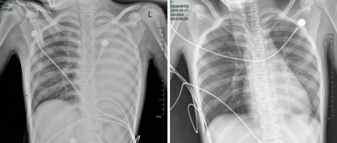 發熱僅1天，肺全白了！這種病極度危險，千萬別當普通感冒